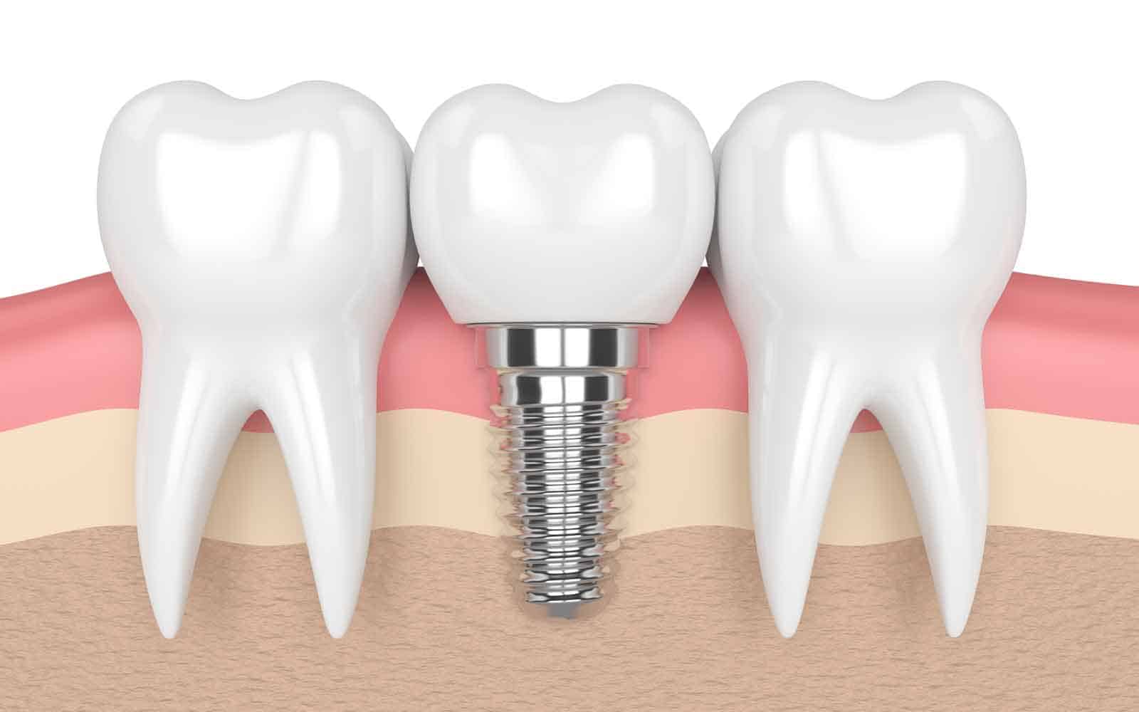 Dental Implants in Turkey, Istanbul
