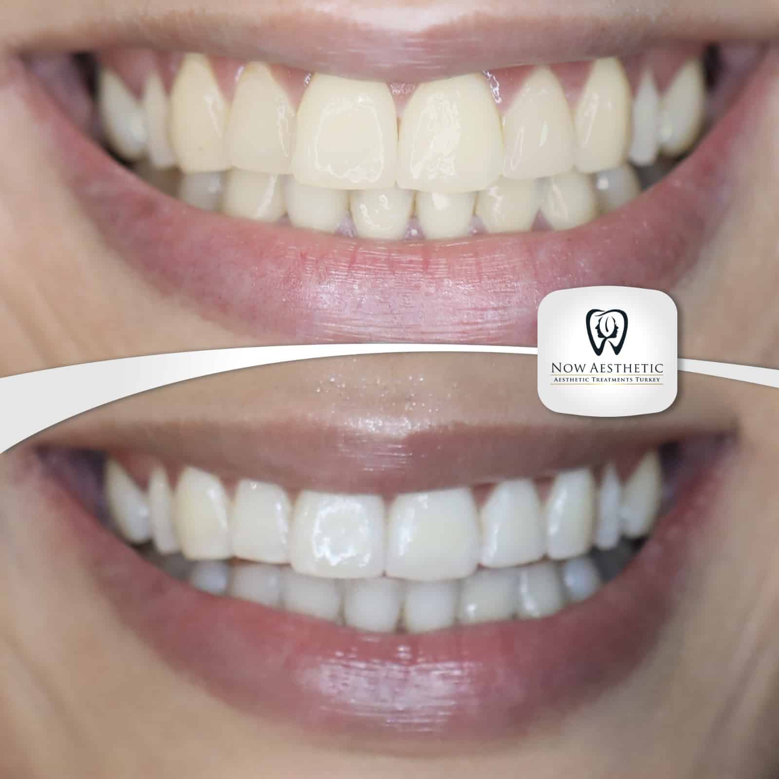 Dental Treatments in Turkey Before and After