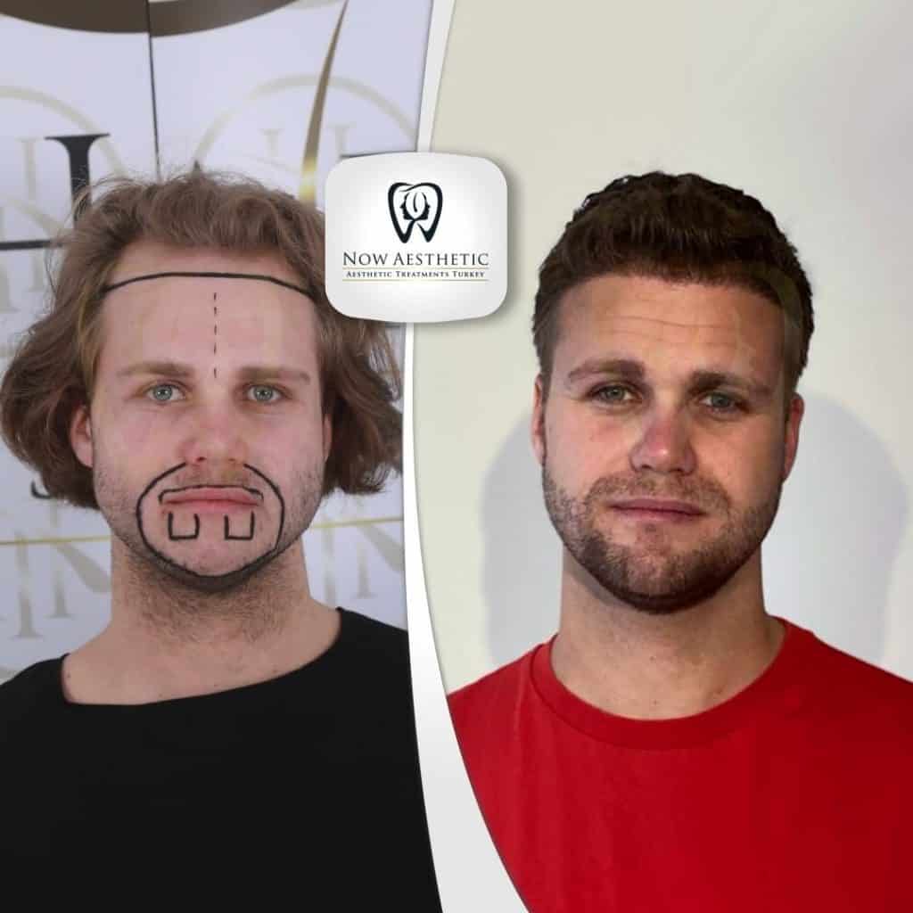 Beard Transplant Before and After 2023 Now Aesthetic