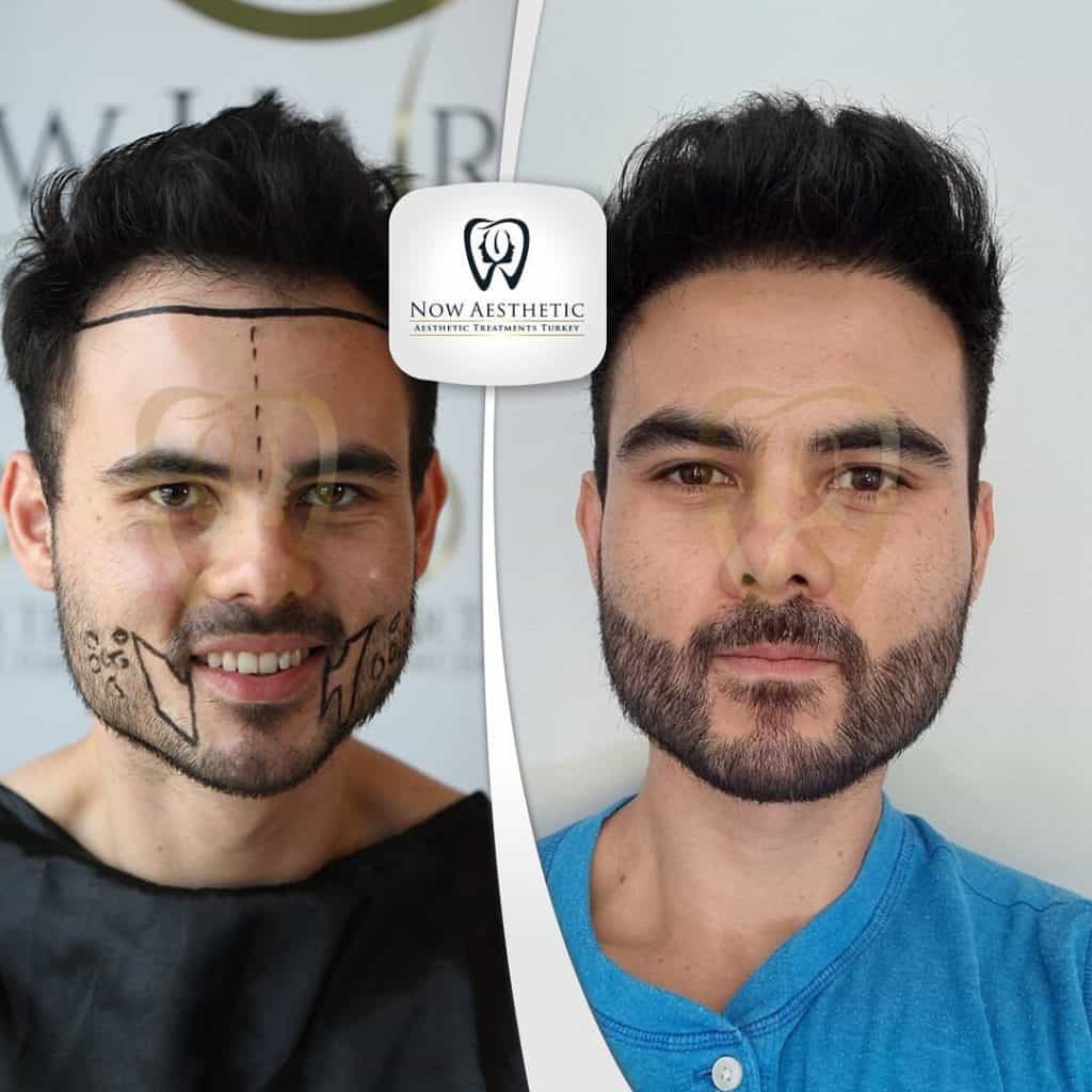 Beard Transplant Before and After 2023 Now Aesthetic