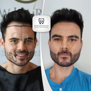 Beard Transplant Before and After