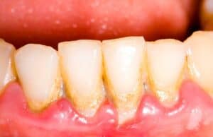 What is Dental Plaque?