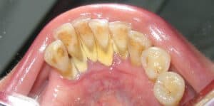 What is Tartar (Dental Calculus)?