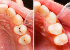What is Dental Filling?