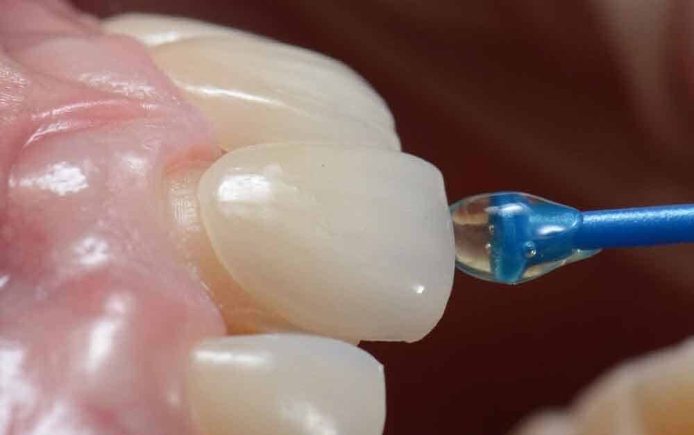 EMax Veneers in Turkey, Istanbul 2023 Now Aesthetic