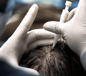 DHI Hair Transplant in Turkey, Istanbul