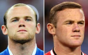 Wayne Rooney Hair Transplant