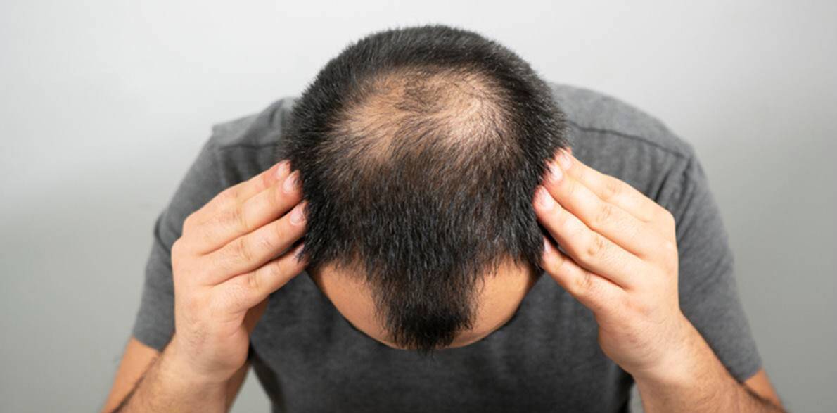 Hair Loss Types Now Aesthetic