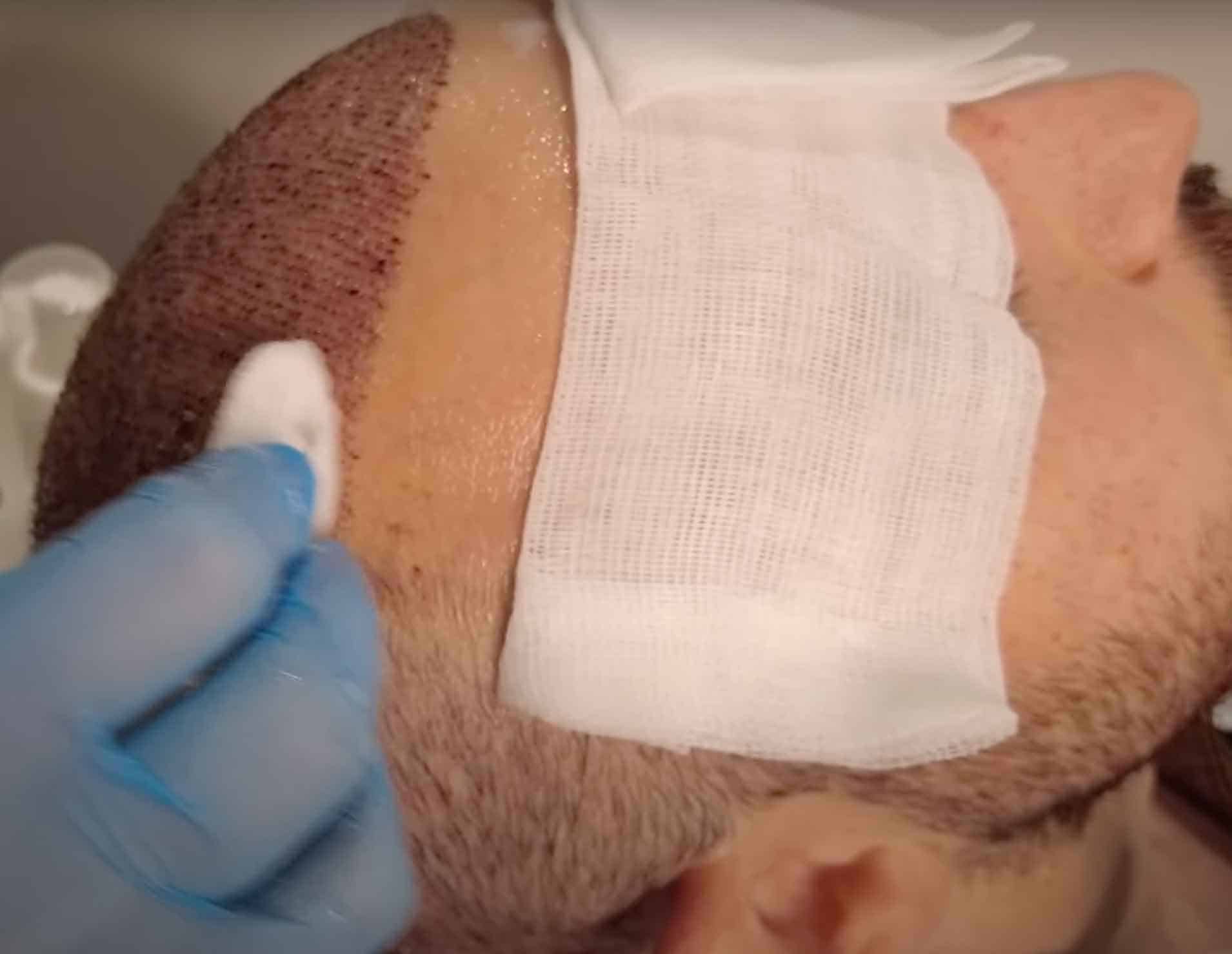 Hair Transplant Aftercare 2022 Now Aesthetic