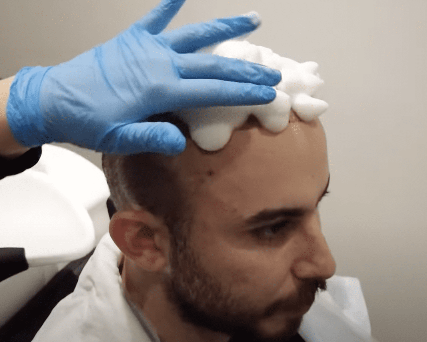 Hair Transplant Scars and Scabs