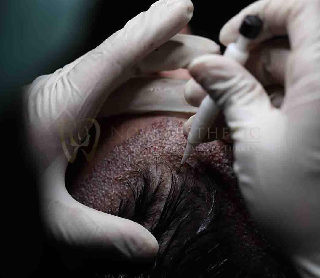 Unshaven Hair Transplant in Turkey, Istanbul