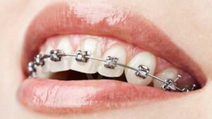 Clip in Braces for Teeth: Everything You Need to Know
