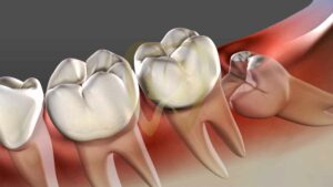 How Many Roots Do Wisdom Teeth Have?