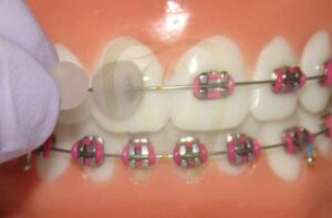 Teeth Brace Wax: A Simple Solution for Orthodontic Discomfort