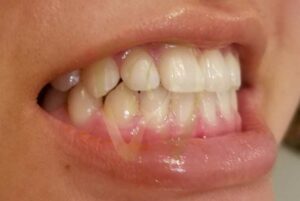 Teeth Flare After Braces: Understanding and Managing the Phenomenon