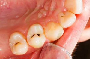 Teeth Rotting from the Inside Out: Causes, Prevention, and Treatment