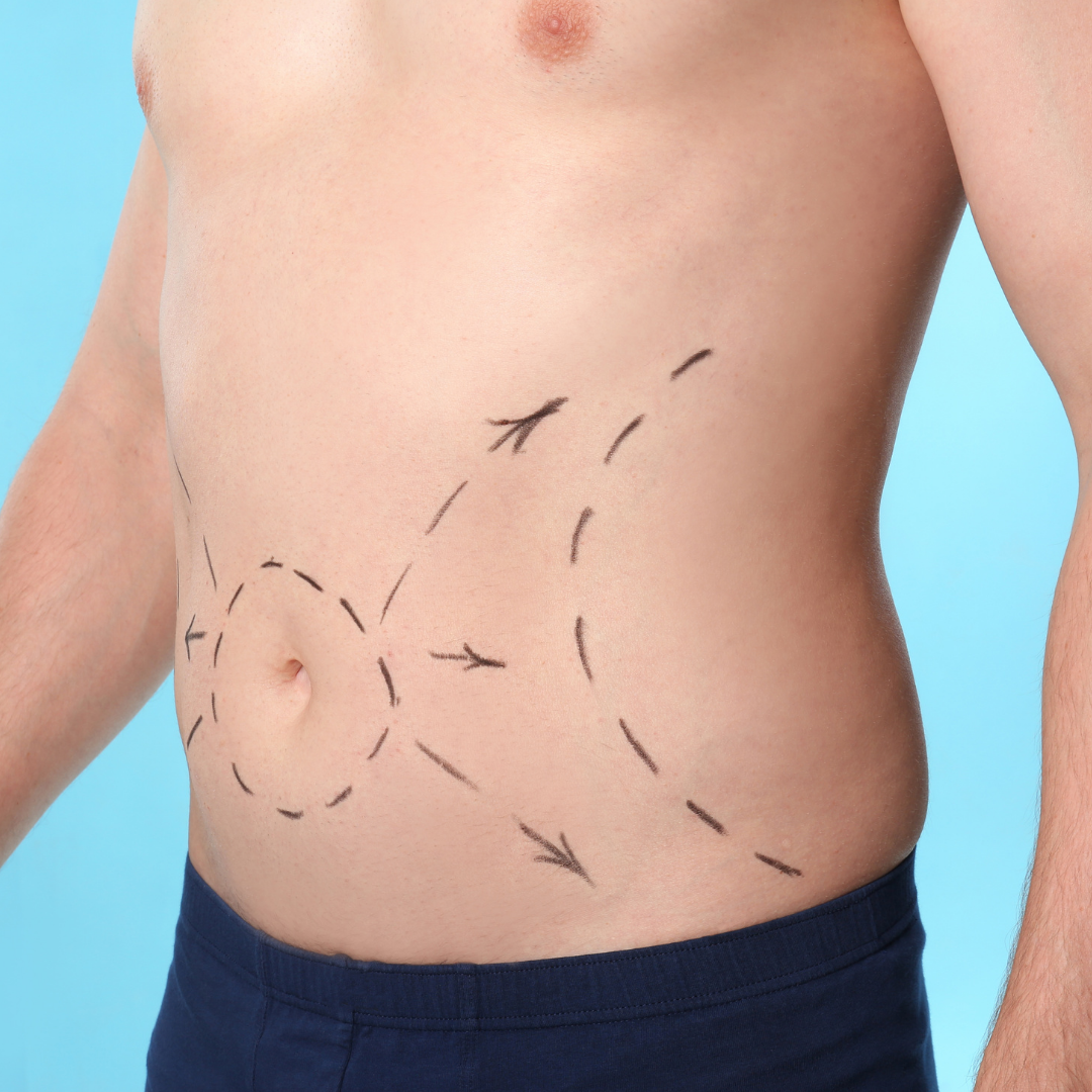 Liposuction for Men