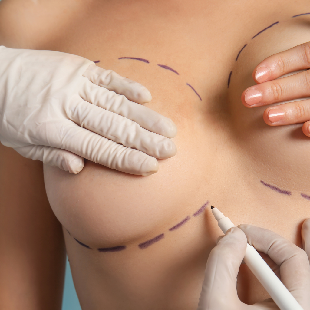 Breast Augmentation