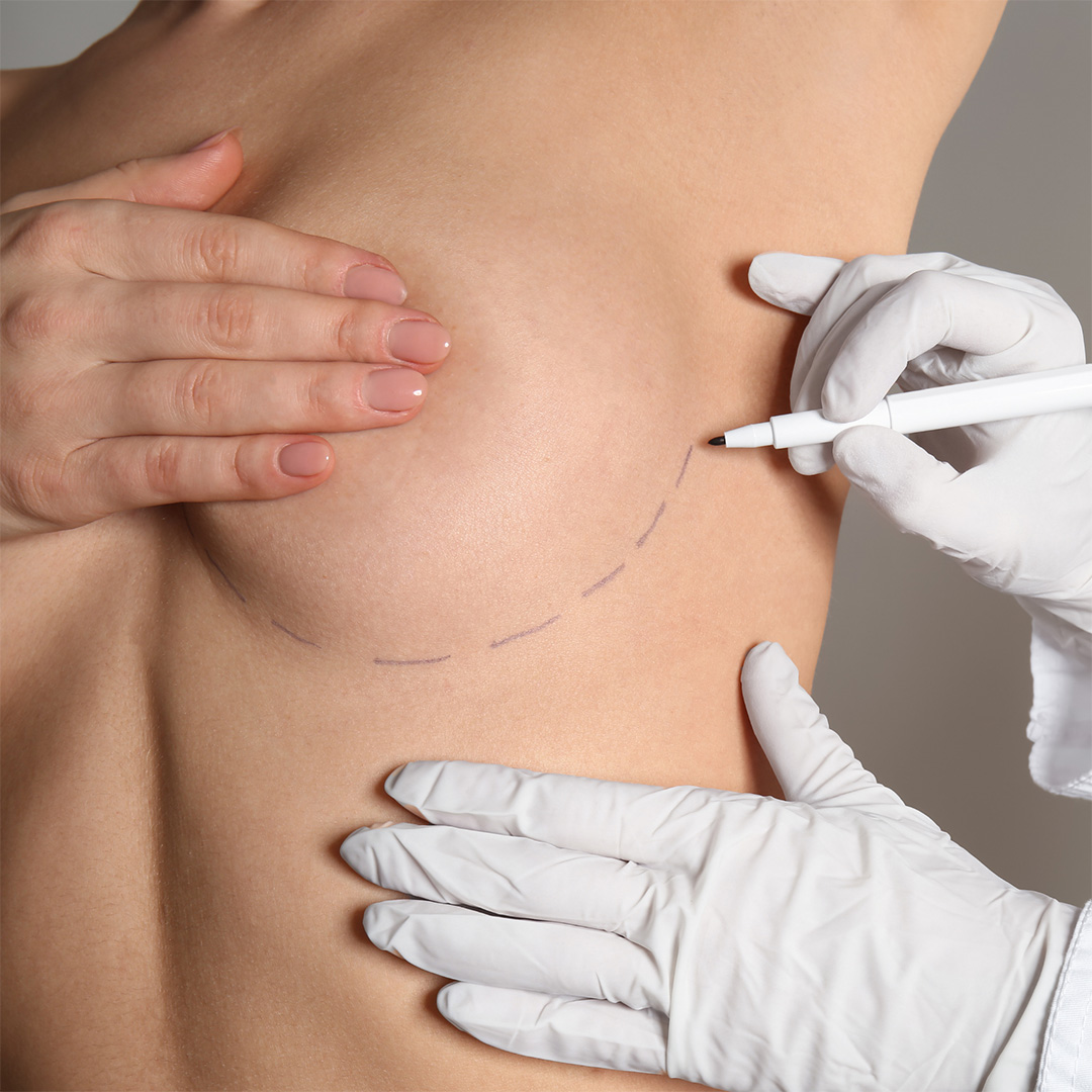 Breast Augmentation