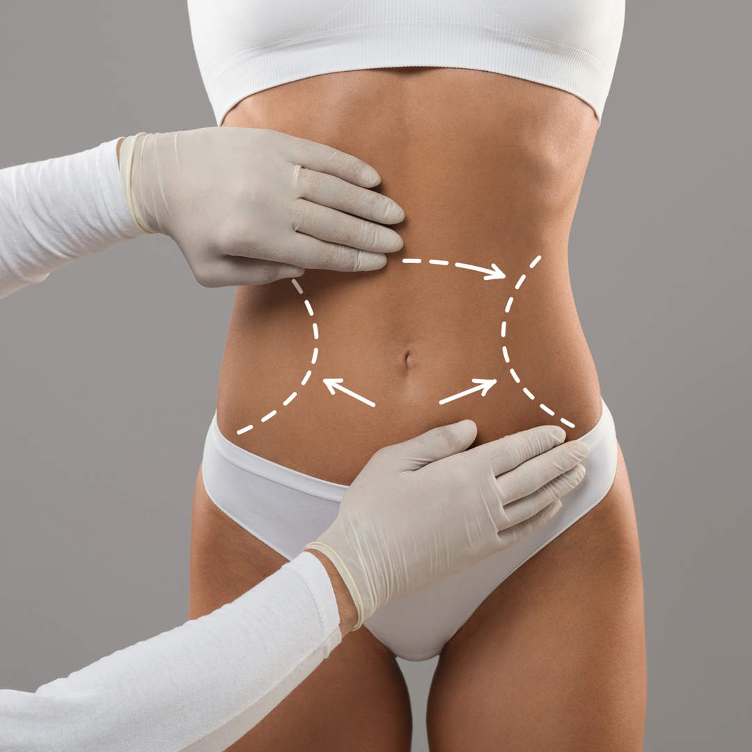 Liposuction in Istanbul, Turkey